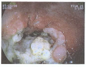 悪性腫瘍ができた腸管